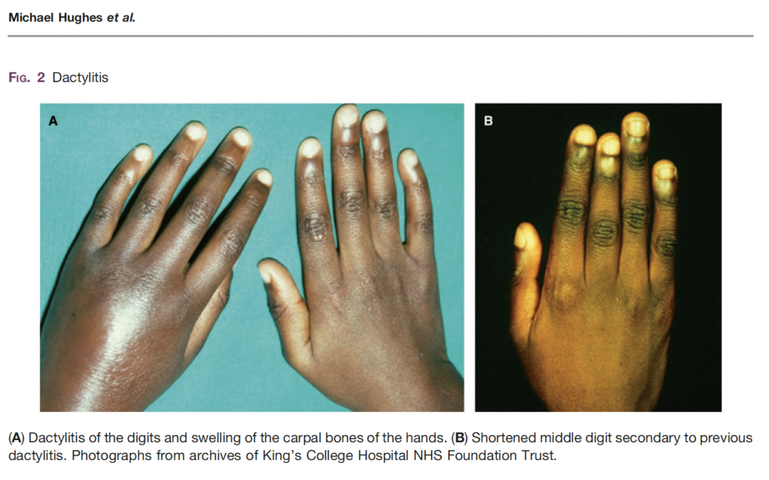 Haemoglobinopathies and the rheumatologist