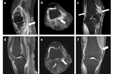 A case of severe knee enthesitis on MRI as an initial presentation of enteropathic arthritis