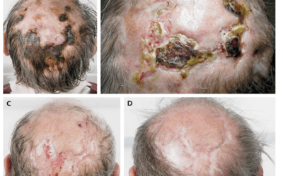 Scalp Necrosis Associated with Giant-Cell Arteritis